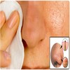 أيقونة Blackheads Removal